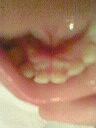 ２号の永久歯